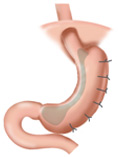 腹腔鏡胃大彎摺疊手術