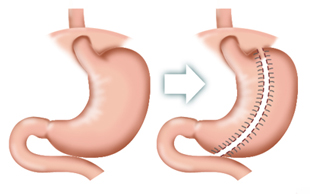 縮胃手術把胃大彎容量縮小