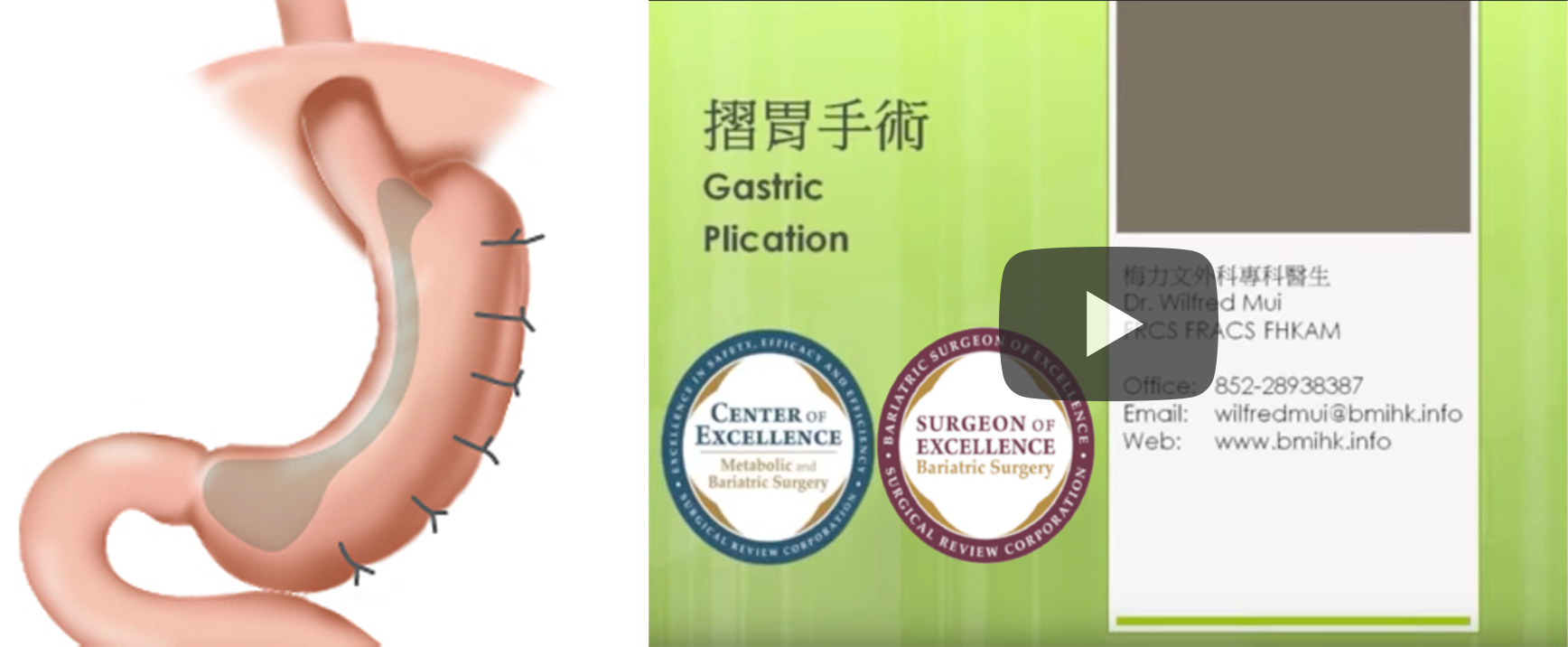 摺胃手術 Gastric Plication
