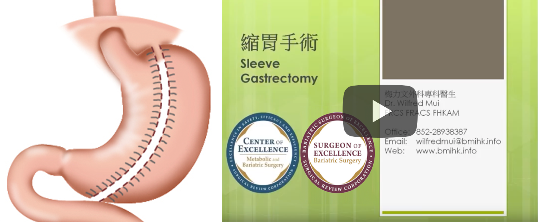 縮胃手術 Sleeve Gastrectomy